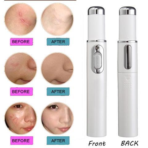 Blue Light Therapy Acne Laser Pen Soft Scar Wrinkle Removal Treatment Device Skin Care Beauty Equipment - watkins innovators
